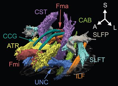 White Matter Features Associated With Autistic Traits in Obsessive-Compulsive Disorder